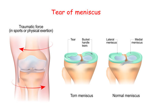 riss eines meniskus - cruciate ligament stock-grafiken, -clipart, -cartoons und -symbole