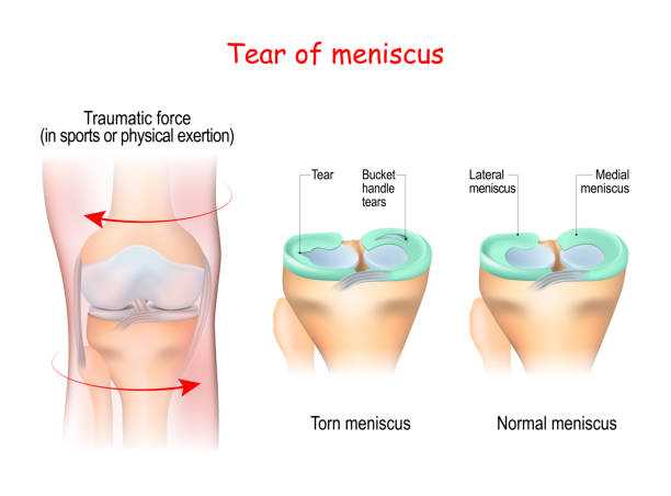 반월 상 연골의 눈물 - cartilage patella human knee medical exam stock illustrations