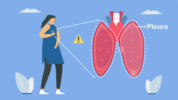istock Pleurisy is pleura that separate lungs from chest wall. And it becomes inflamed. Pulmonology vector illustration about restrictive lung disease. 1257231072