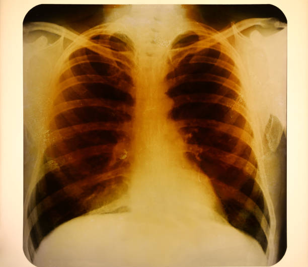 Close up vintage roentgenogram or photofluorogram (fluorogram) with ribcage and lungs