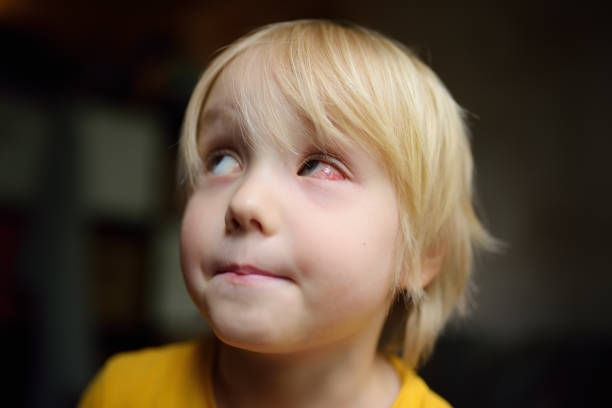 chłopiec przedszkolak z czerwonym pęknięciem naczyń krwionośnych w oku. zapalenie spojówek, uraz oka, zapalenie, zakażenie, alergia lub ciśnienie wewnątrzgałkowe są powodem do skontaktowania się z okulistą. - conjunctivitis sore eyes child human eye zdjęcia i obrazy z banku zdjęć