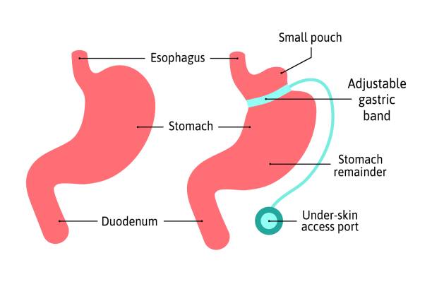 illustrations, cliparts, dessins animés et icônes de diagramme anatomique d’illustration médicale de bande gastrique. la chirurgie divise l’estomac en deux parties avec la bande. anatomie humaine d’estomac isolée sur le fond blanc. système d’organe d’estomac et de digestion, illustration vectori - human large intestine