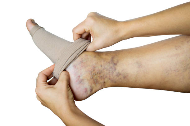 A Woman Puts A Compression Stocking On Her Leg With Varicose Veins Varicose  Veins Prevention Compression Tights Relief For Tired Legs Female Legs In  Stockings Stock Photo - Download Image Now - iStock