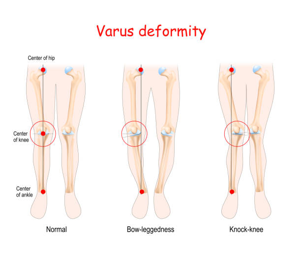 valgus deformities. healthy joint, knock-knee and Bow-leggedness valgus deformities. healthy joint, knock-knee and Bow-leggedness. Human legs, bones and joints. deformed stock illustrations