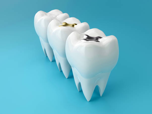 istock Teeth with gold, amalgam and composite inlay dental filling, perspective view. Different types of fillings, 3d render 1257571432