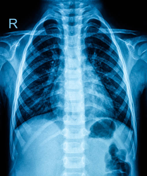 Thoracic cavity X-ray Film