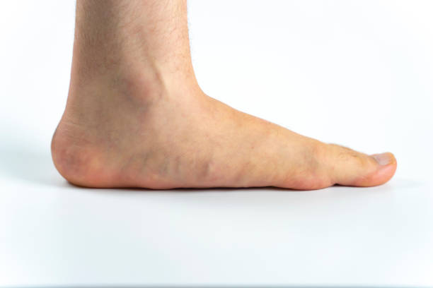 una condición médica avanzada de pies planos (pes planus o arcos caídos) - talus fotografías e imágenes de stock