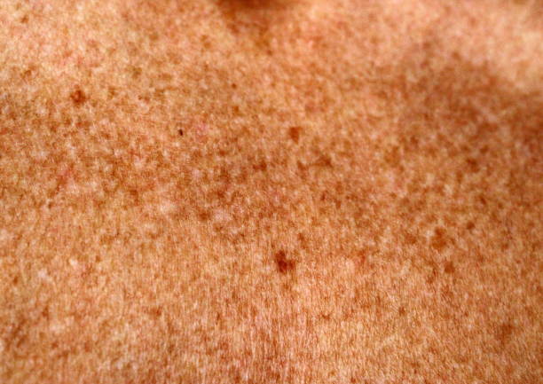 istock Freckles, age spots after long exposure to the sun. 1257709255