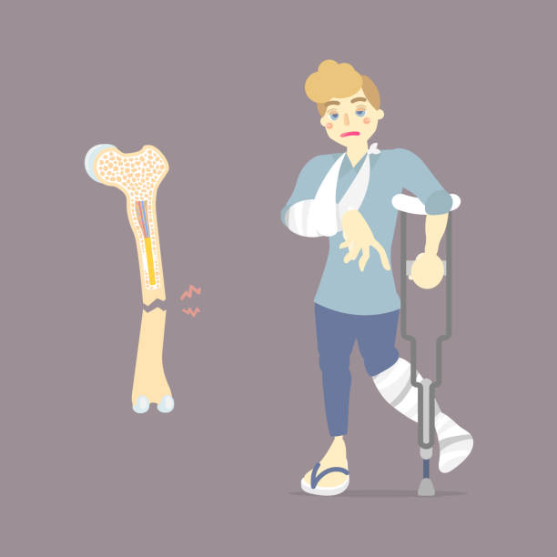 Sad Patient With Cast On Broken Leg And Arm Bone Holding Crutch Walking Aid  Internal Organs Body Part Orthopedic Health Care Fracture Concept Stock  Illustration - Download Image Now - iStock