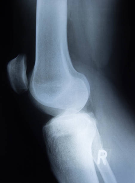 radiographie du genou humain - x ray human knee orthopedic equipment human bone photos et images de collection