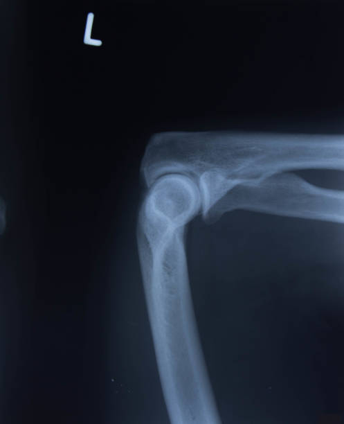 radiographie du genou humain - x ray human knee orthopedic equipment human bone photos et images de collection