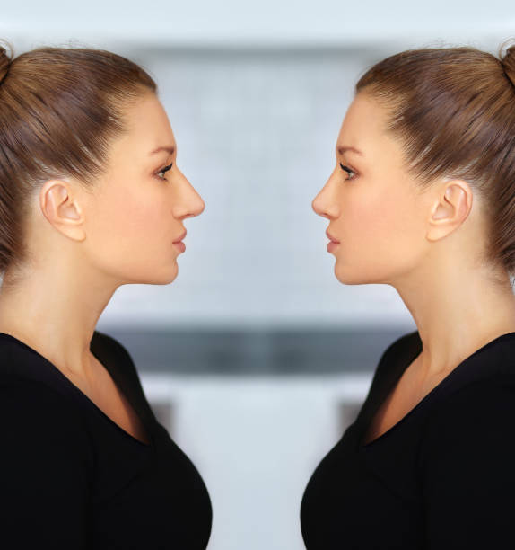 istock Rhinoplasty.Before and after. process of reconstructing nose 1257765246