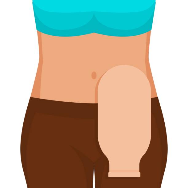 Young woman with colostomy bag Young woman with colostomy bag. Vector illustration stomata stock illustrations