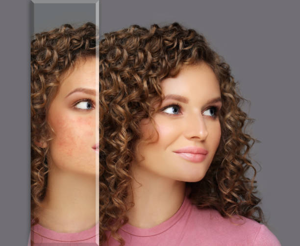 istock Post-Acne Marks /Treating Acne Scars.Acne Scar Removal 1257928253