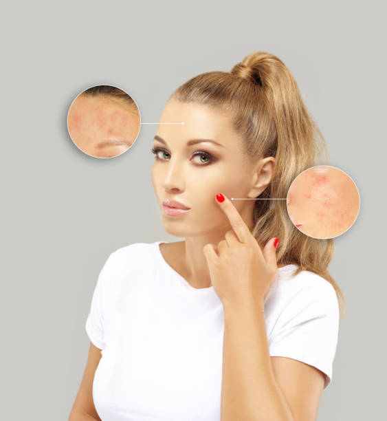 istock Post-Acne Marks /Treating Acne Scars.Acne Scar Removal 1258097813