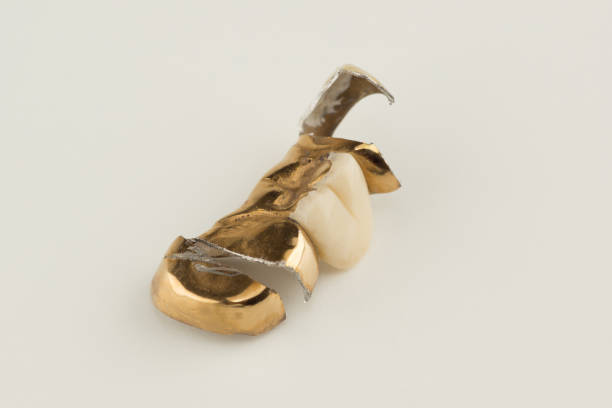 istock damaged stamped brazed dental bridge 1258141338