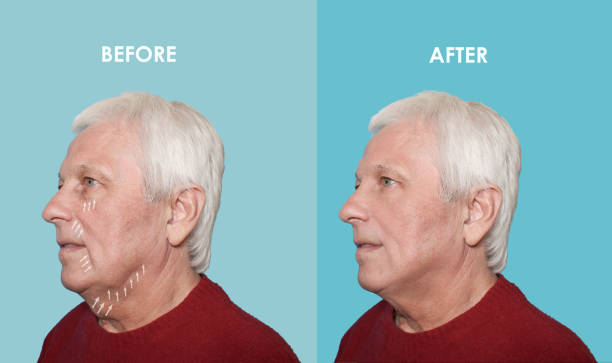 istock The male lifting before and after procedures 1259041971