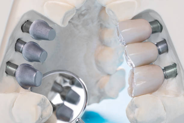 istock Close up implant and prosthodontic model. 1259551145