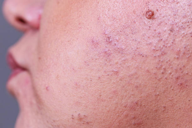 Skin Wart With A Hair Stock Photos, Pictures & Royalty-Free Images - iStock Skin Wart With A Hair Stock Photos, Pictures & Royalty-Free Images - iStock