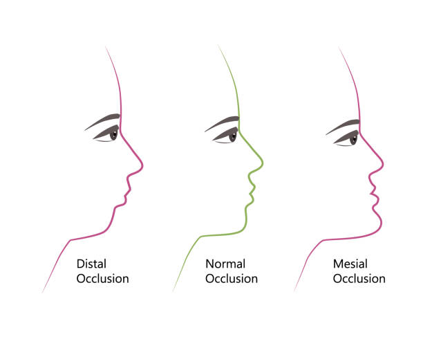 distal, Normal, and Mesial bite profile, vector illustration. Overbite or underbite before and after orthodontic treatment. Human with malocclusion, bite correction by braces concept distal, Normal, and Mesial bite profile, vector illustration. Overbite or underbite before and after orthodontic treatment. Human with malocclusion, bite correction by braces concept. overbite stock illustrations