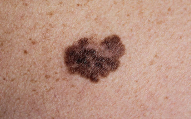 Melanoma - a malignant tumor of the skin Photos of melanoma without magnification and with a tenfold magnification using a dermatoscope mole stock pictures, royalty-free photos & images