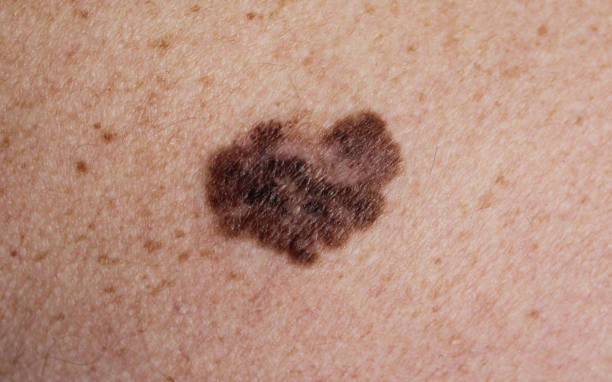 czerniak - złośliwy nowotwór skóry - melanoma mole human skin dermatology zdjęcia i obrazy z banku zdjęć