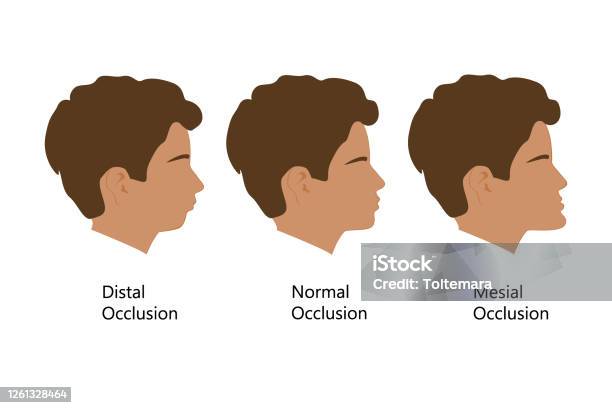 Normal Bite Pattern Guy With Distal Normal And Mesial Bite Profile Vector Illustration ...