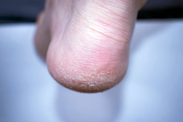 istock Dry skin on the feet 1261421383