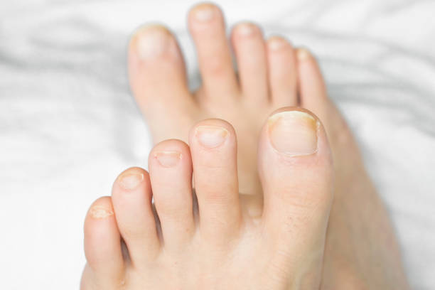 zehennägel auf den füßen einer frau - fungus toenail human foot onychomycosis stock-fotos und bilder