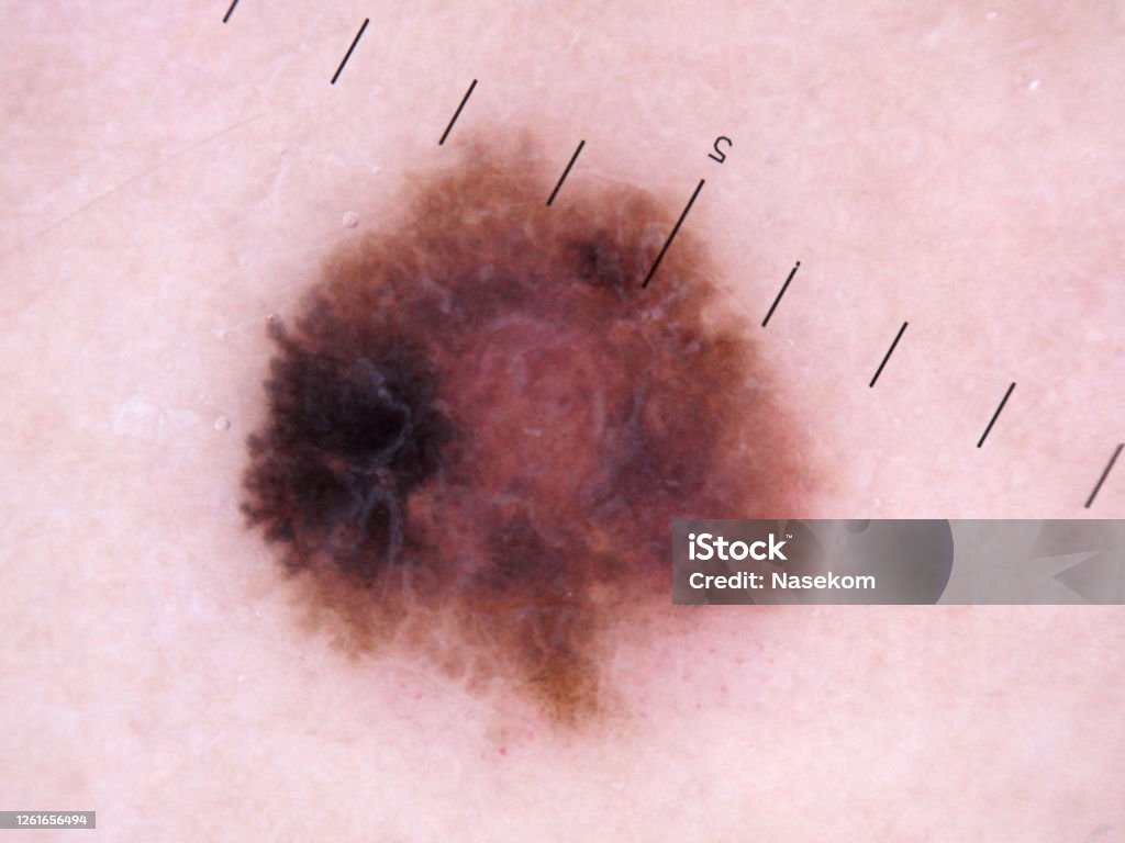 흑색종 인간의 피부의 악성 종양 흑색종에 대한 스톡 사진 및 기타 이미지 - 흑색종, 전이성 종양, 피부암 - Istock