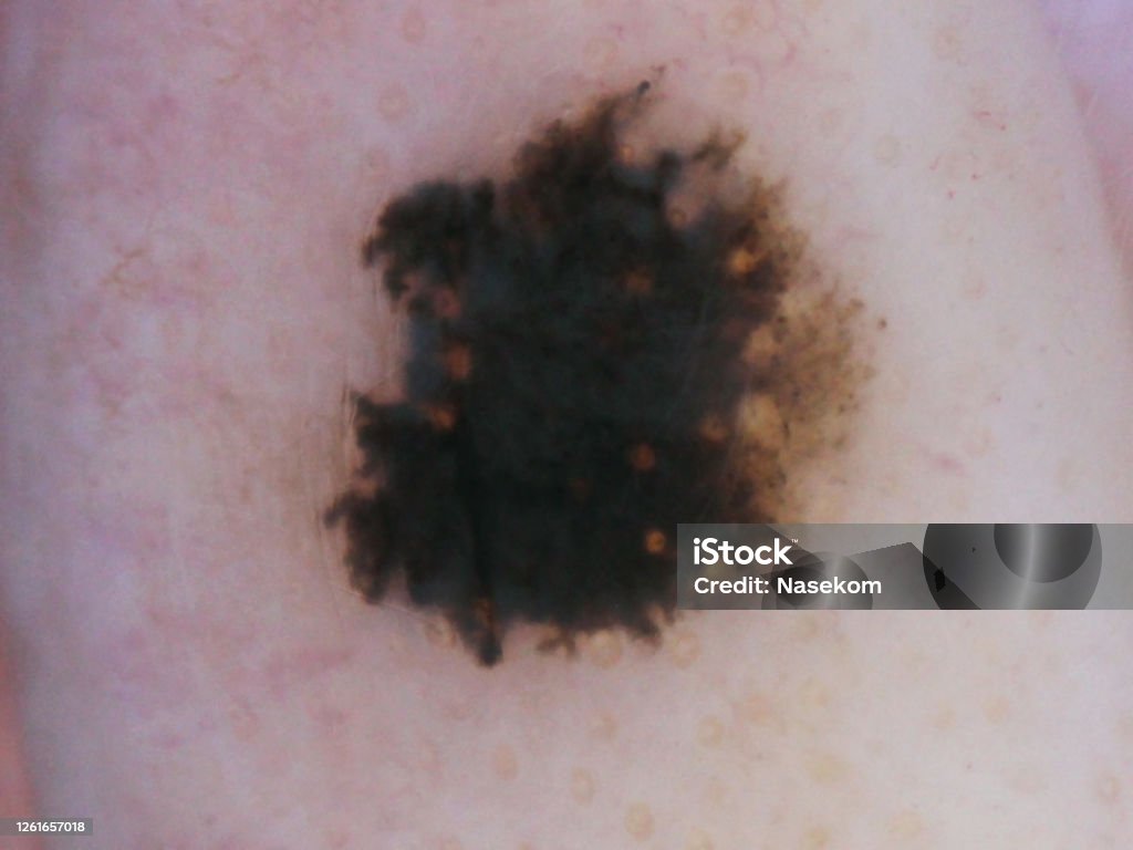 흑색종 인간의 피부의 악성 종양 전이성 종양에 대한 스톡 사진 및 기타 이미지 - 전이성 종양, 피부암, 흑색종 - Istock