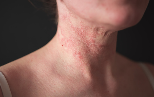 la chica tiene dermatitis en el cuello sobre un fondo negro photo