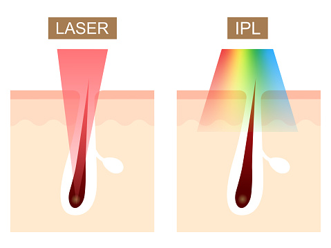 Laser And Ipl Hair Removal Differences Skin Care Concept Stock Illustration - Download Image Now - iStock Laser And Ipl Hair Removal Differences Skin Care Concept Stock Illustration - Download Image Now - iStock