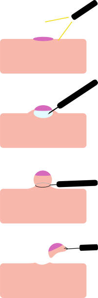 abbildung eines chirurgischen eingriffs zur entfernung eines polyp - darmspiegelung stock-grafiken, -clipart, -cartoons und -symbole