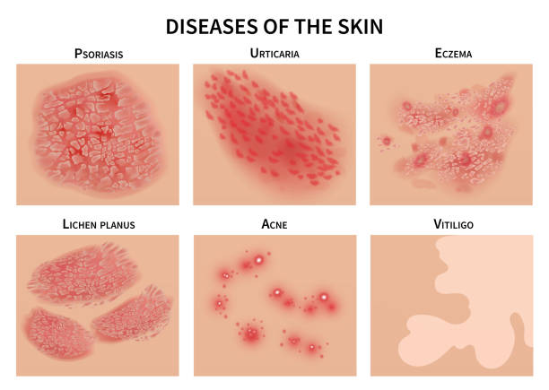 Skin diseases. Derma infection, eczema and psoriasis. Dermatology vector illustration Skin diseases. Derma infection, eczema and psoriasis. Dermatology vector illustration. Disease medical epidermis, dermatitis infection vitiligo stock illustrations
