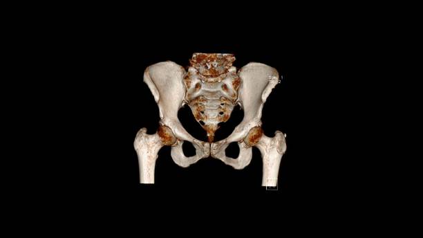 istock Computed Tomography Volume Rendering examination of the  pelvic bones 1262412934
