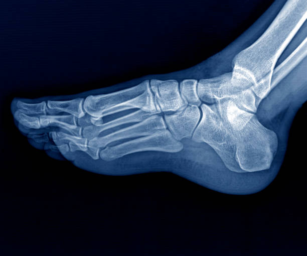 röntgenaufnahme der ferse nach calcaneus fraktur stock foto - bending human foot ankle x ray image stock-fotos und bilder