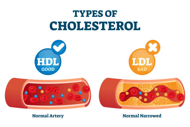 Cholesterol types comparison with HDL and LDL lipoprotein vector illustration Types of cholesterol comparison with HDL and LDL lipoprotein vector illustration. Labeled educational normal and narrowed artery cross section explanation. Physiological high fat diet problem example. cholesterol stock illustrations
