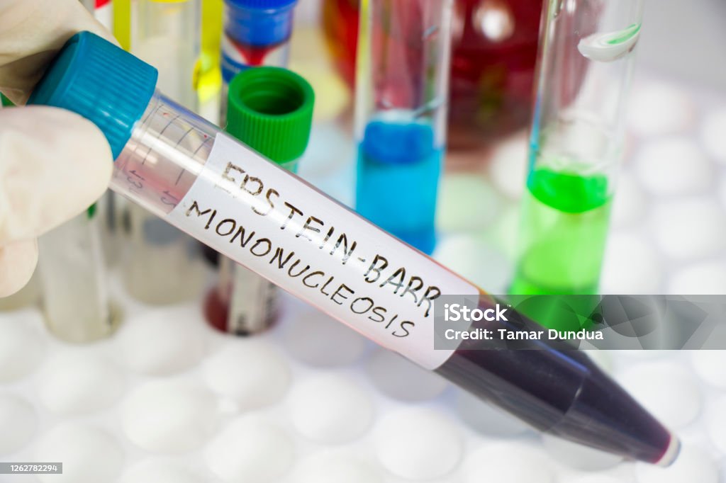 Mononucleosis And Epsteinbarr Virus Blood Test Sample In Lab On The Mononucleosis And Epsteinbarr Virus Blood Test Sample In Lab On The