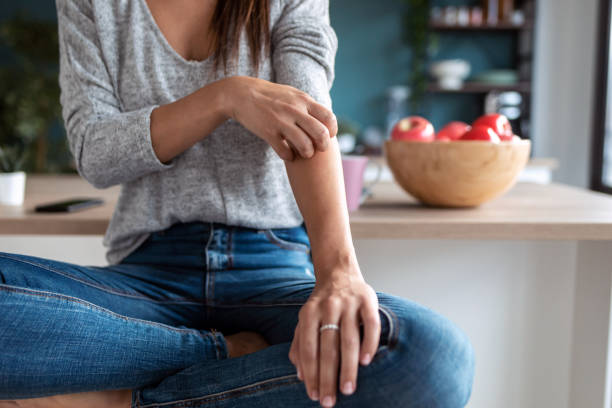 jeune femme se grattant le bras tout en s’asseyant sur le tabouret dans la cuisine de la maison. - eczema photos et images de collection