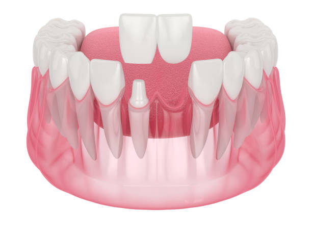 istock 3d render of  jaw with dental cantilever bridge 1263051433