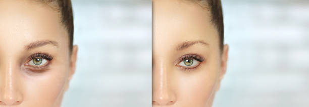 istock Eyelid surgery/Blepharoplasty,plastic surgeon,before and after 1263079418