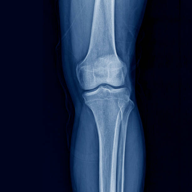 zdjęcie z obrażeń sportowych - x ray human knee orthopedic equipment human bone zdjęcia i obrazy z banku zdjęć
