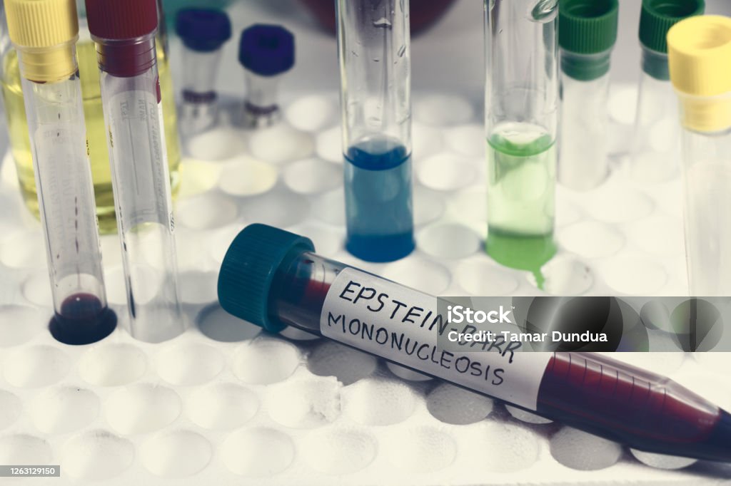 Mononucleosis And Epsteinbarr Virus Blood Test Sample In Lab On The Mononucleosis And Epsteinbarr Virus Blood Test Sample In Lab On The