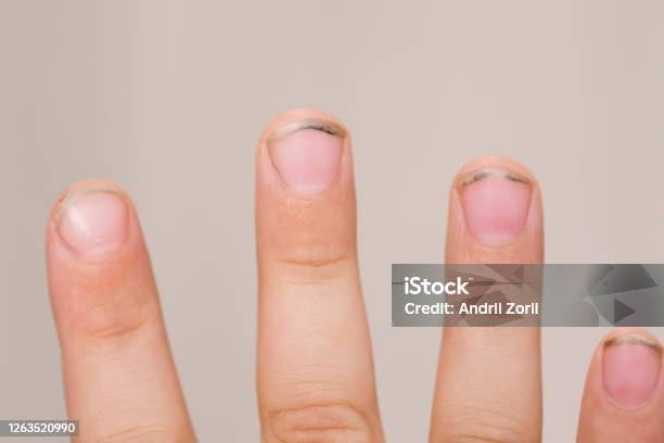 Las Uñas Largas Sucias Hacen Que Los Gérmenes Se Enfermen Suciedad Bajo Las Uñas De Un Las Uñas Largas Sucias Hacen Que Los Gérmenes Se Enfermen Suciedad Bajo Las Uñas De Un