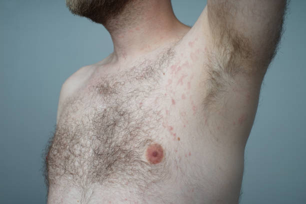 アレルギー反応は、若い男性の体に赤い斑点です。 - angioedema ストックフォトと画像