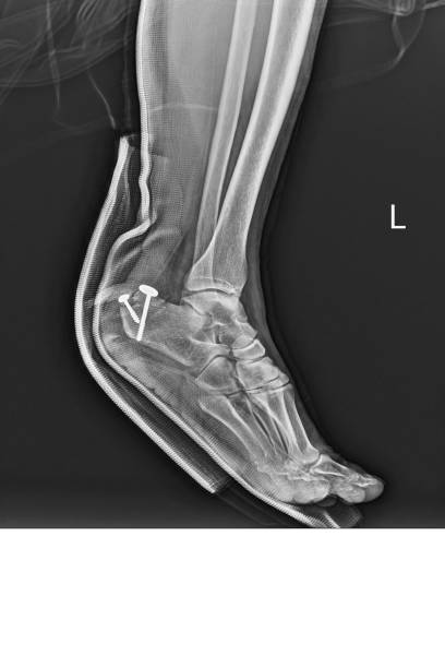 istock Film ankle X-ray radiograph showing heel bone broken treated by open reduction and internal fixation(ORIF) with screws(close fracture calcaneus) . Medical technology and healthcare concept. 1263635709