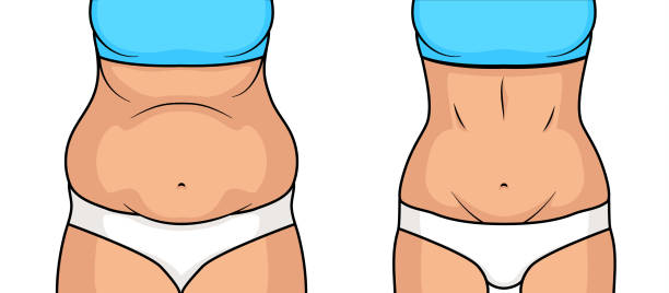 ilustraciones, im�ágenes clip art, dibujos animados e iconos de stock de cirugía plástica de pérdida de grasa del vientre femenina. abdomen chica grasa abdominales pierden antes y después de la celulitis - the human body cartoon figurine characters