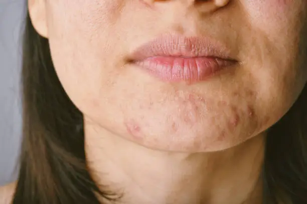 Skin problem with acne diseases, Close up woman face with whitehead pimples on chin, Menstruation breakout, Scar and oily greasy face, Beauty concept.