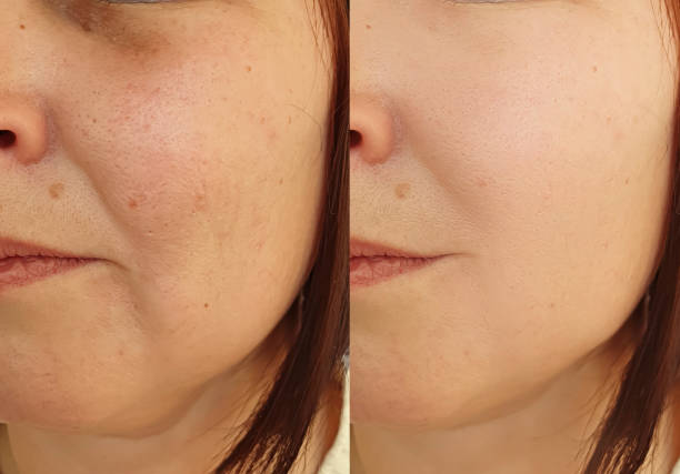 istock woman face wrinkles before and after treatment collage 1263853886